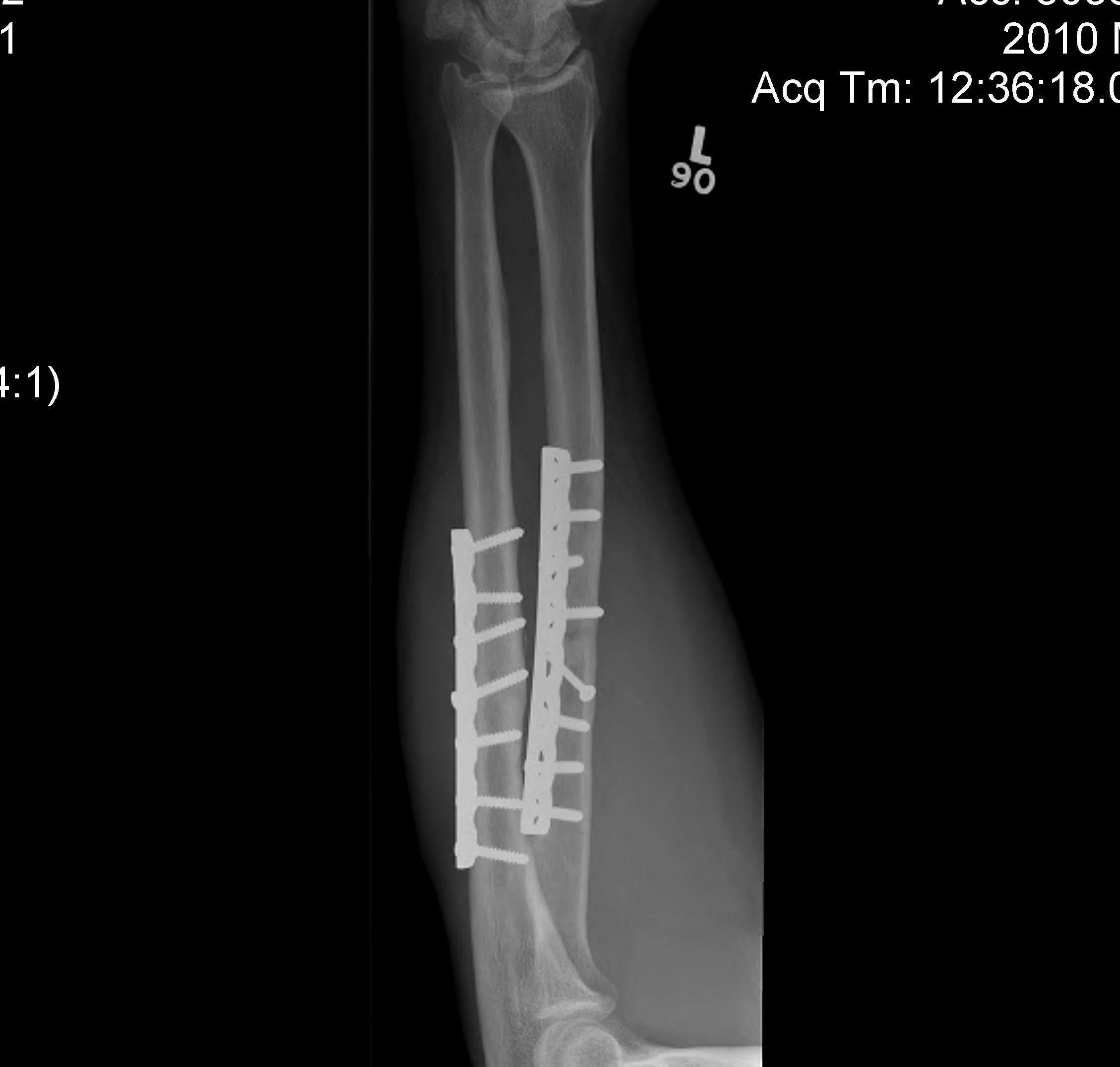Forearm Fractures Plate AP